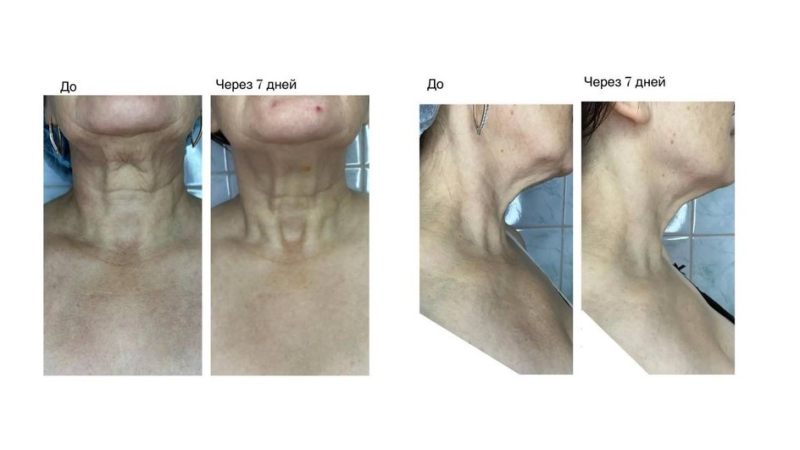 Биоревитализация: что это за процедура, какие используются препараты, фото с эффектом на лице до и после, цены и отзывы