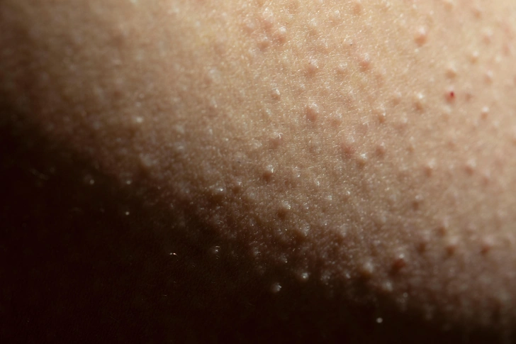 Strawberry legs: как с ними бороться, чтобы не стесняться носить юбки