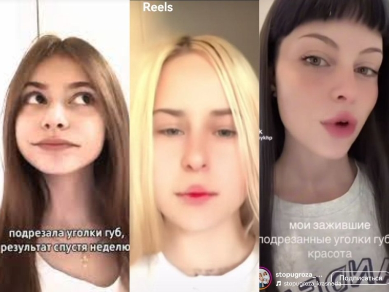 тренд на подрезание уголков губ: что это такое, зачем подростки режут губы, почему нельзя самостоятельно подрезать уголки губ
