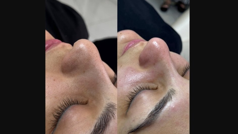 Эффект от комбинированной чистки лица: плюсы и минусы, чем отличается от ультразвуковой