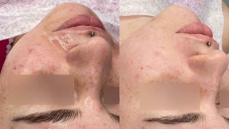 Эффект от миндального пилинга: польза процедуры, фото до и после, как выглядит лицо