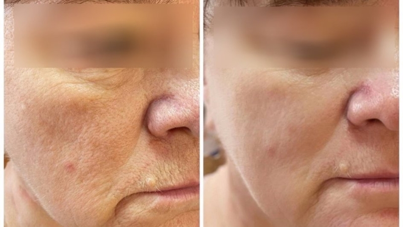Эффект от миндального пилинга: польза процедуры, фото до и после, как выглядит лицо