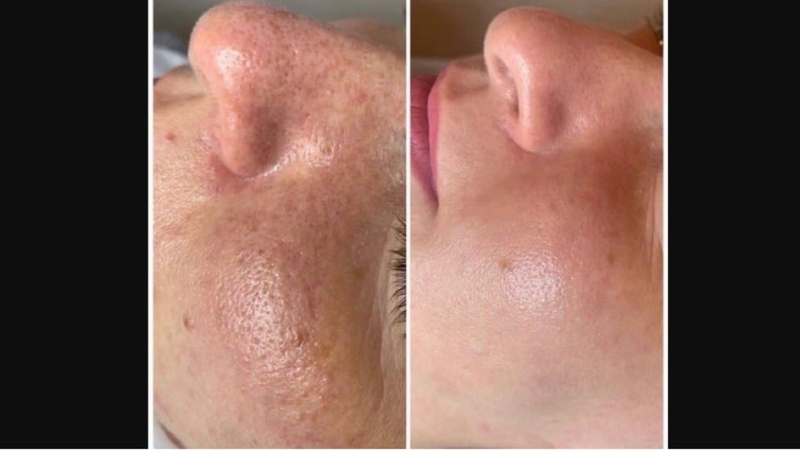 Эффект от желтого пилинга: польза процедуры, фото до и после, как выглядит лицо