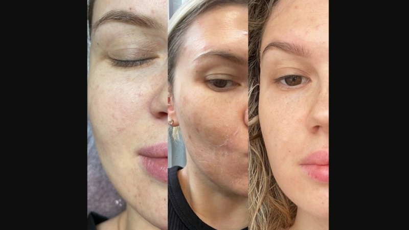 Эффект от желтого пилинга: польза процедуры, фото до и после, как выглядит лицо