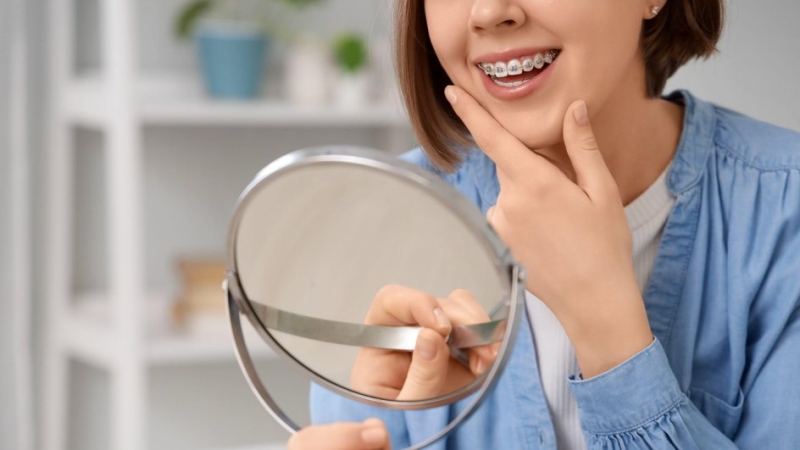 Мифы о брекетах: что такое элайнеры, можно ли ставить брекеты после 50, нужна ли диета с брекетами, рекомендации врача