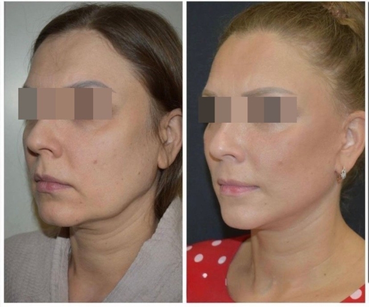 Ботокс для лица: что такое ботокс, в какие зоны лица делают инъекции, сколько длится эффект