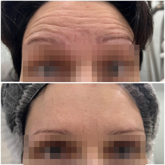 Ботокс для лица: что такое ботокс, в какие зоны лица делают инъекции, сколько длится эффект