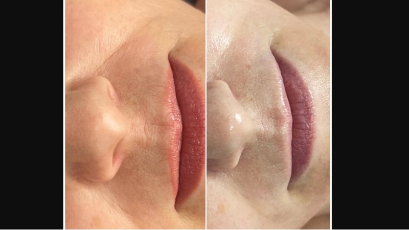 Эффект от карбокситерапии для лица: польза и вред процедуры, фото до и после