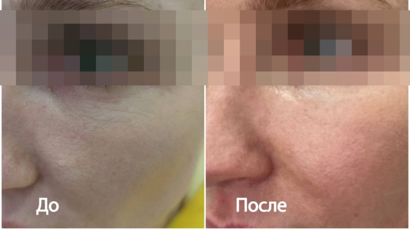 Эффект от пилинга Джесснера: польза процедуры, фото до и после, как выглядит лицо