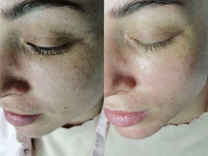 Гликолевый пилинг для лица: секрет сияющей кожи