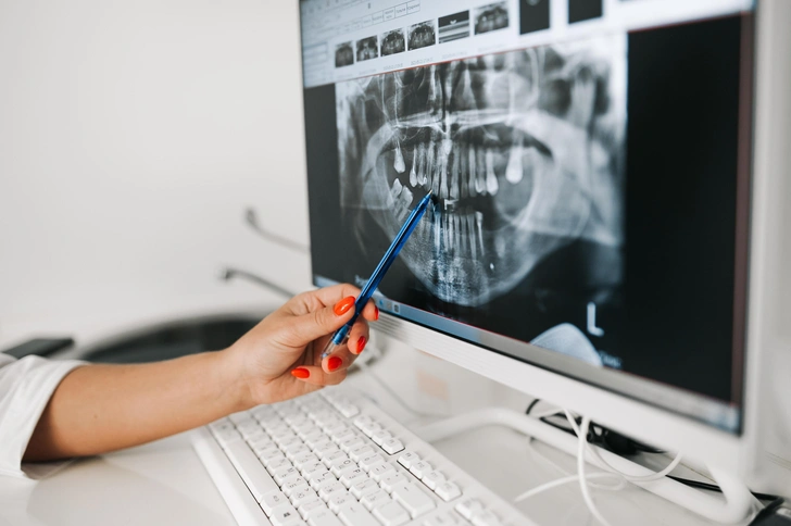 Имплантация зубов: что важно знать, если вы все еще боитесь вернуть улыбку